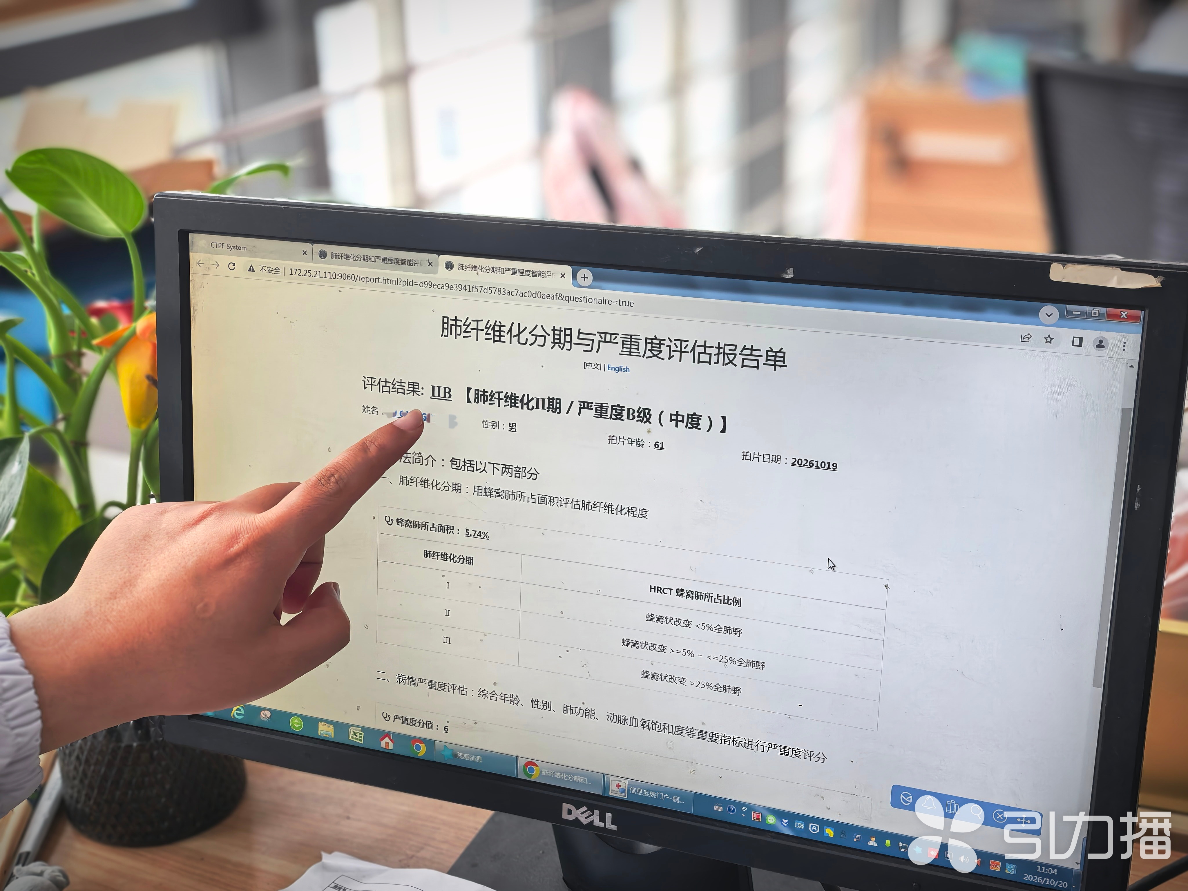 市民的肺纤维化评估报告。苏报融媒记者 李静/摄